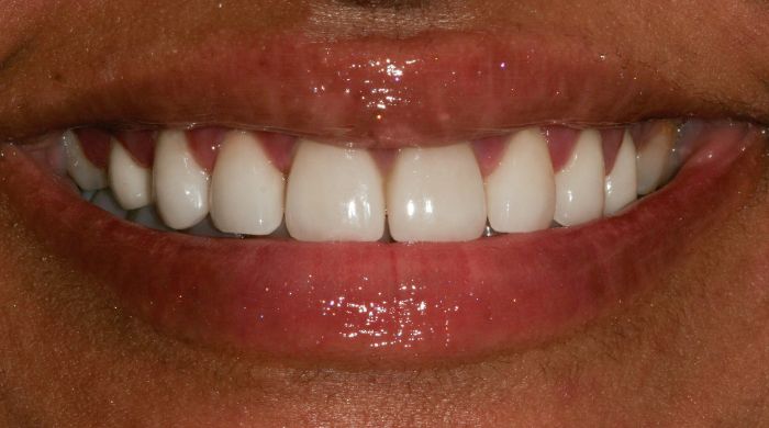 After - Staly Dental