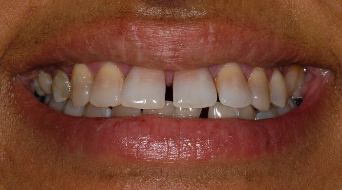 Before - Staly  Dental