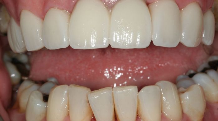 After - Staly Dental