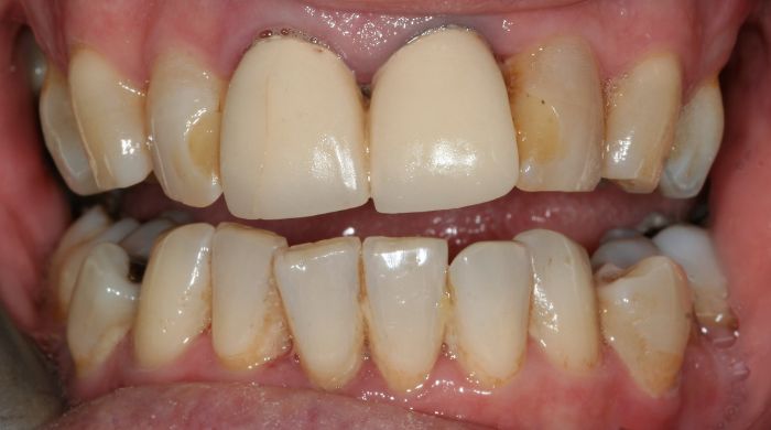 Before - Staly  Dental