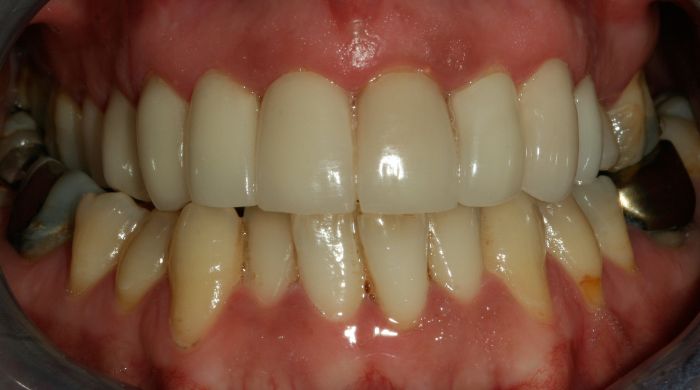 After - Staly Dental