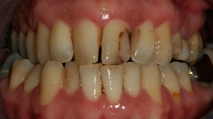 Before - Staly  Dental