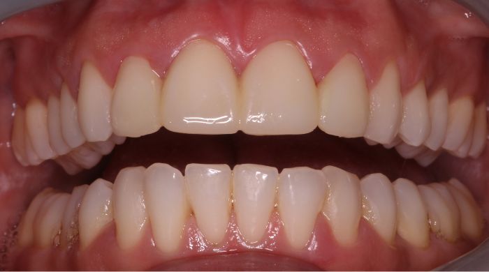 After - Staly Dental