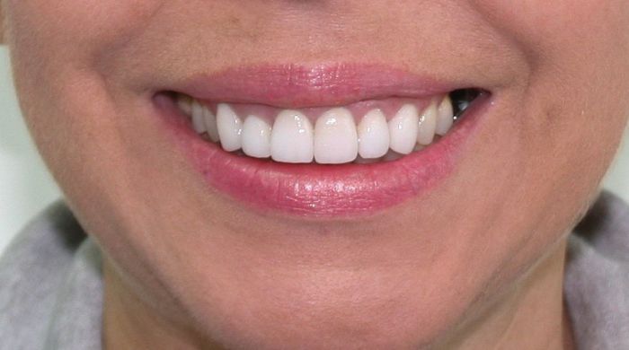 After - Staly Dental