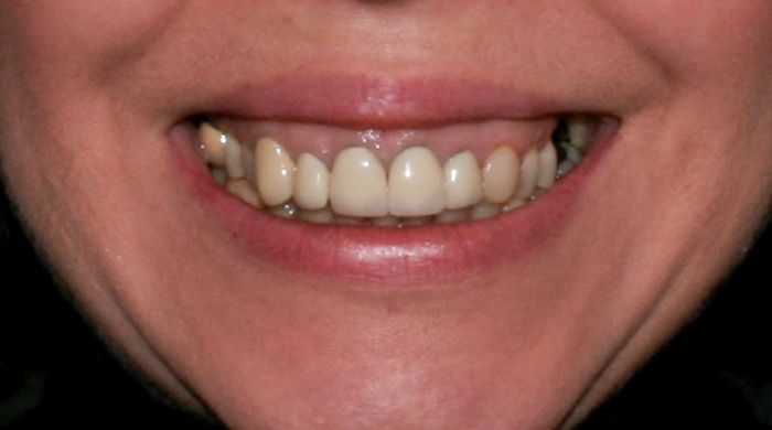 Before - Staly  Dental