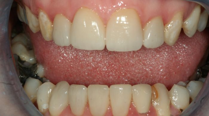 After - Staly Dental