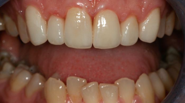 After - Staly Dental