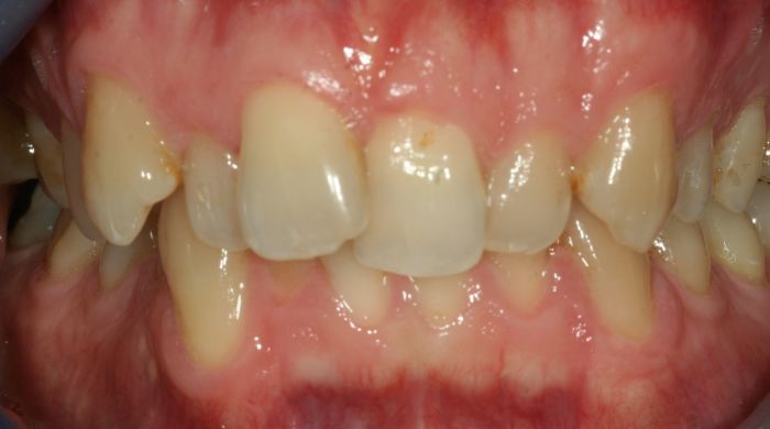 Before - Staly  Dental