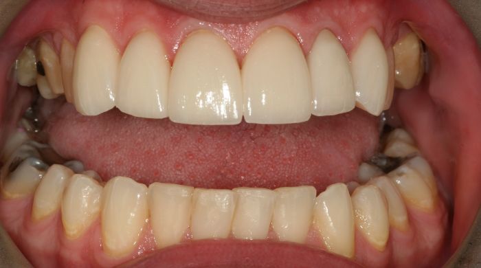 After - Staly Dental