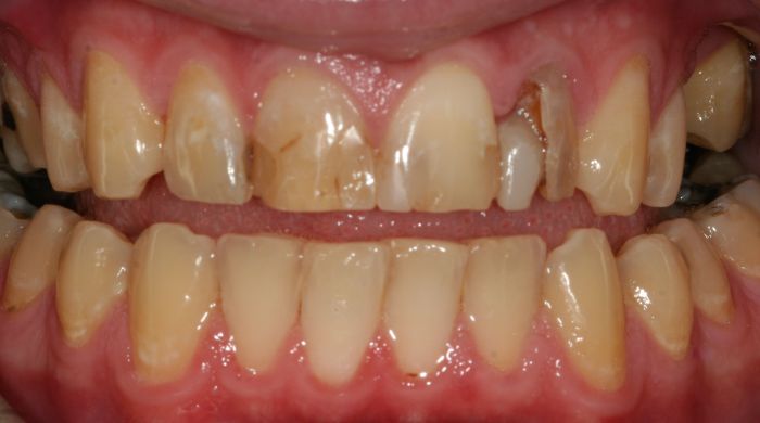 Before - Staly  Dental