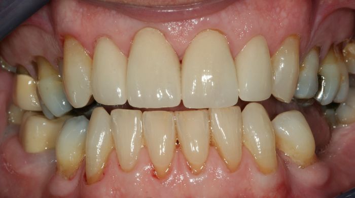 After - Staly Dental