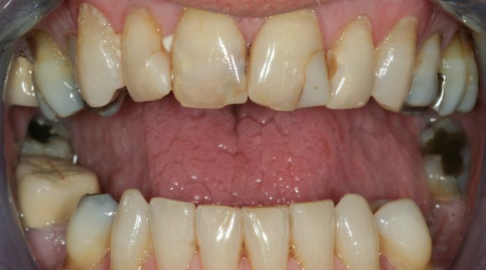 Before - Staly  Dental