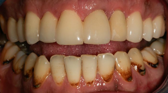 After - Staly Dental