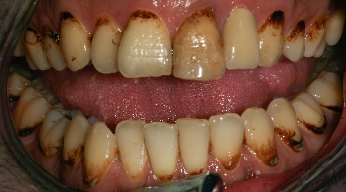 Before - Staly  Dental