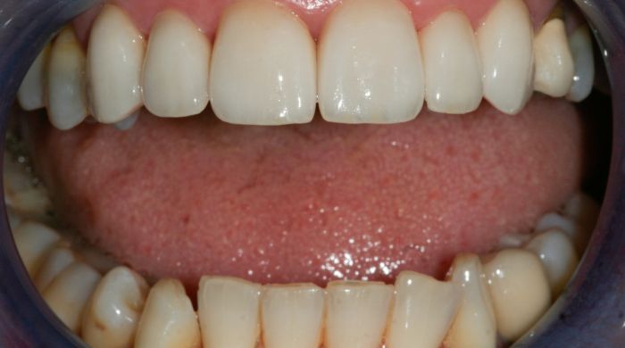 After - Staly Dental