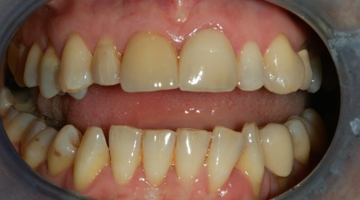 Before - Staly  Dental