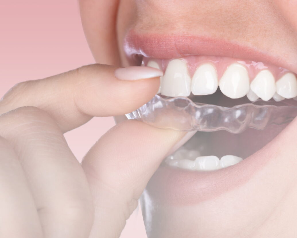  invisalign_image