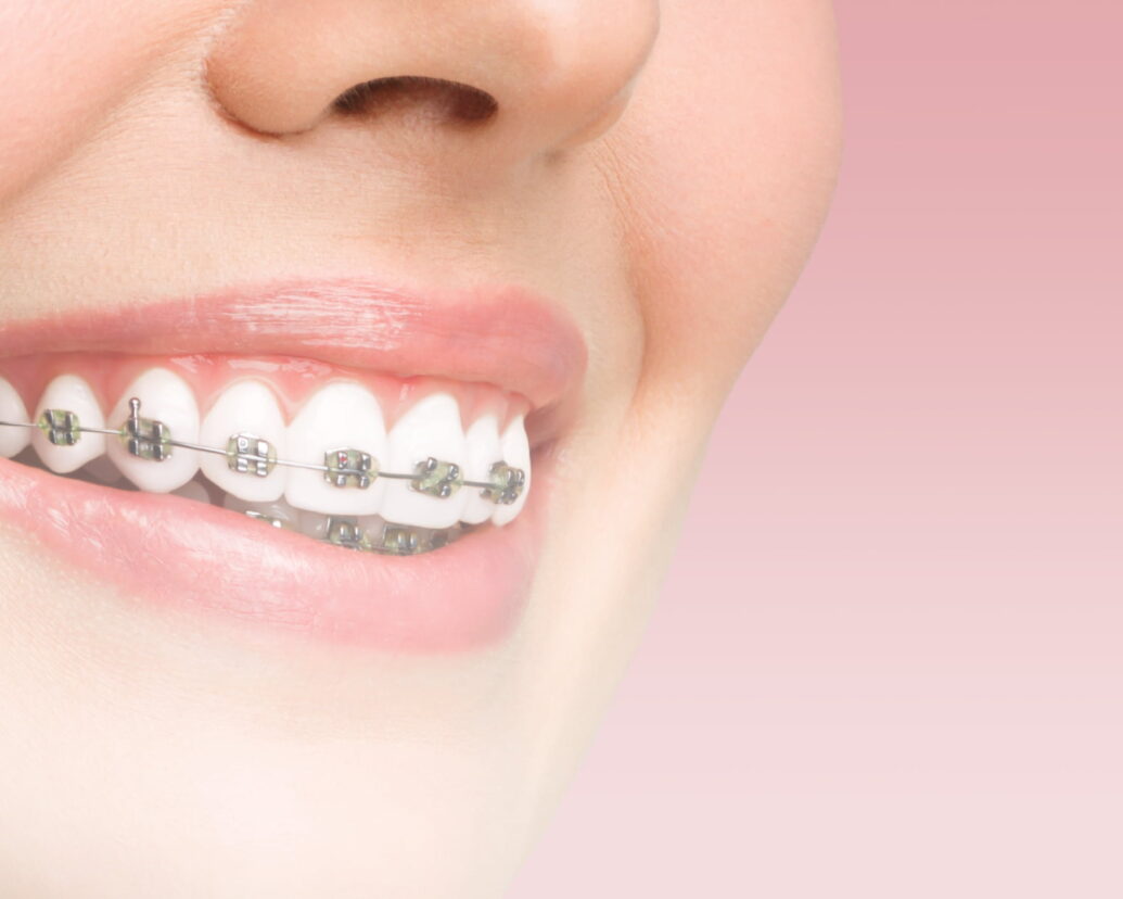  invisalign_image