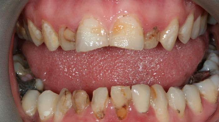 Before - Staly  Dental