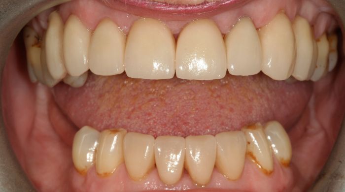 After - Staly Dental