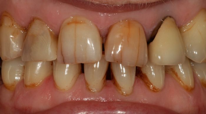 Before - Staly  Dental