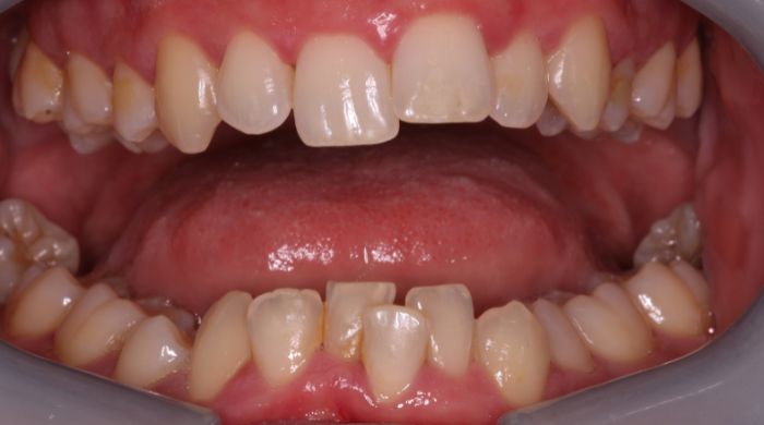 Before - Staly  Dental