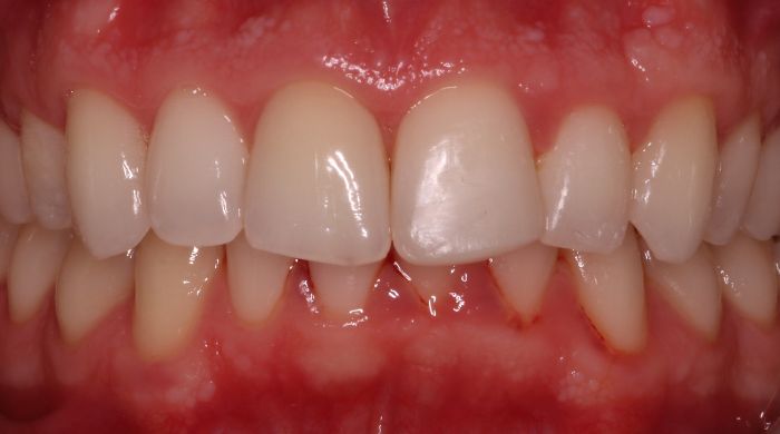 After - Staly Dental