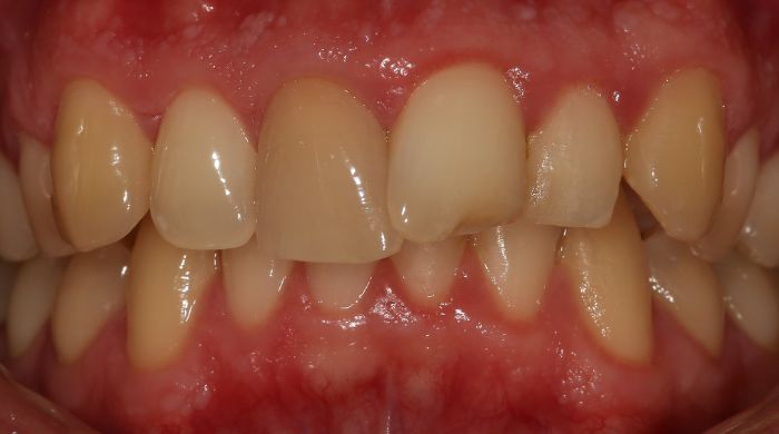 Before - Staly  Dental