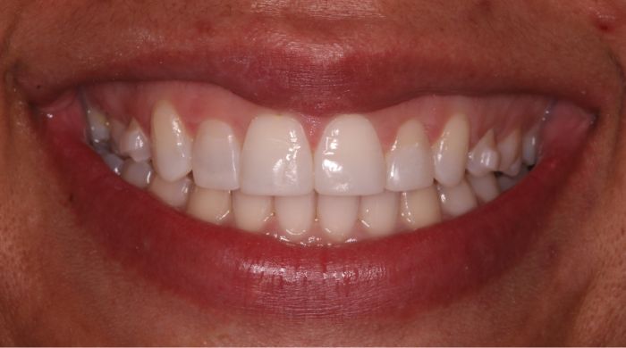 After - Staly Dental