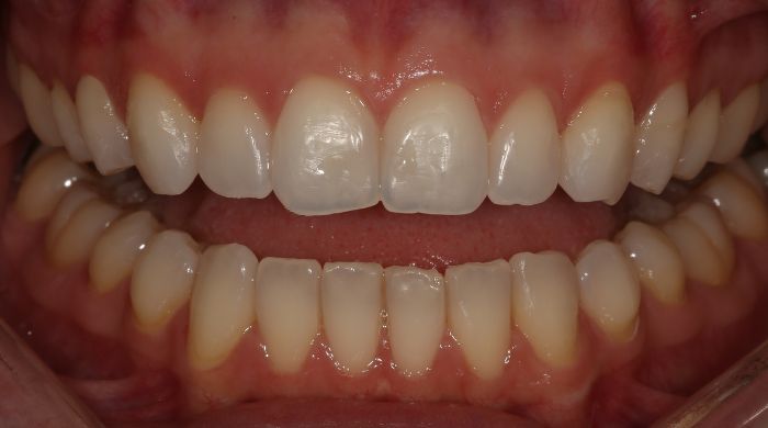 After - Staly Dental