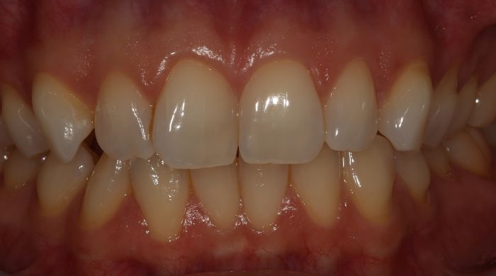 Before - Staly  Dental