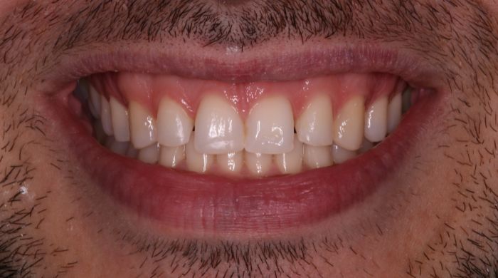 After - Staly Dental