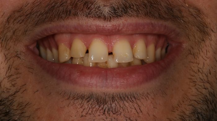 Before - Staly  Dental