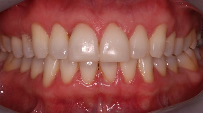 After - Staly Dental