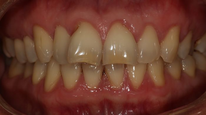 Before - Staly  Dental