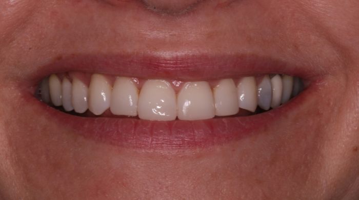 After - Staly Dental