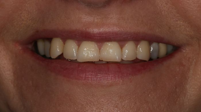 Before - Staly  Dental