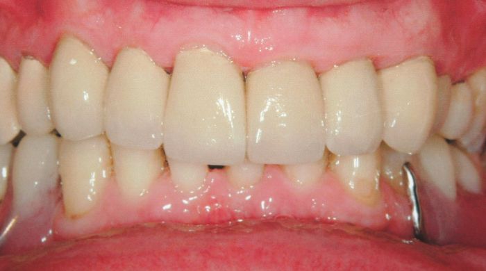 After - Staly Dental