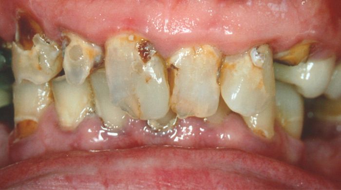 Before - Staly  Dental