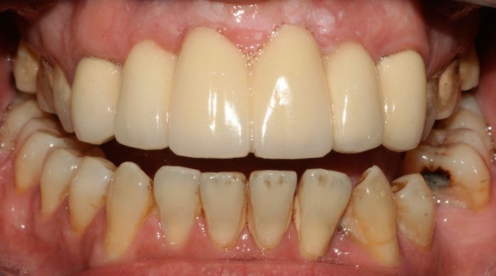 After - Staly Dental