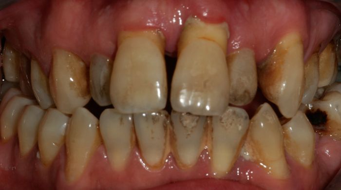 Before - Staly  Dental