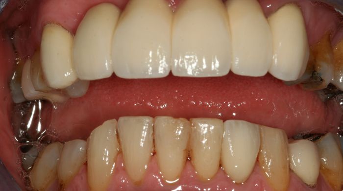 After - Staly Dental