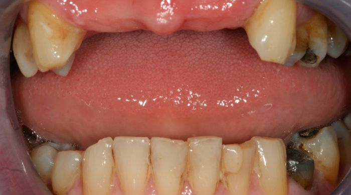 Before - Staly  Dental