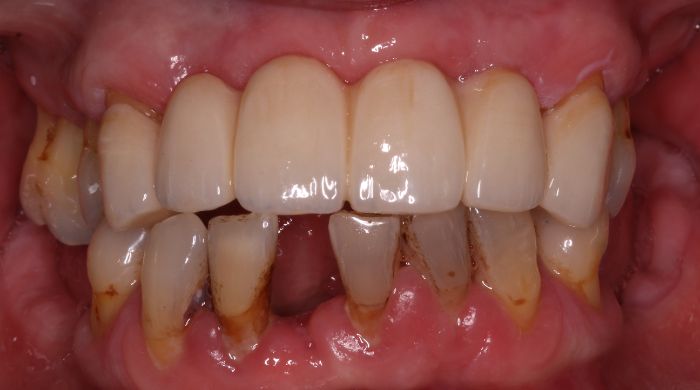 After - Staly Dental