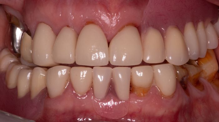 After - Staly Dental