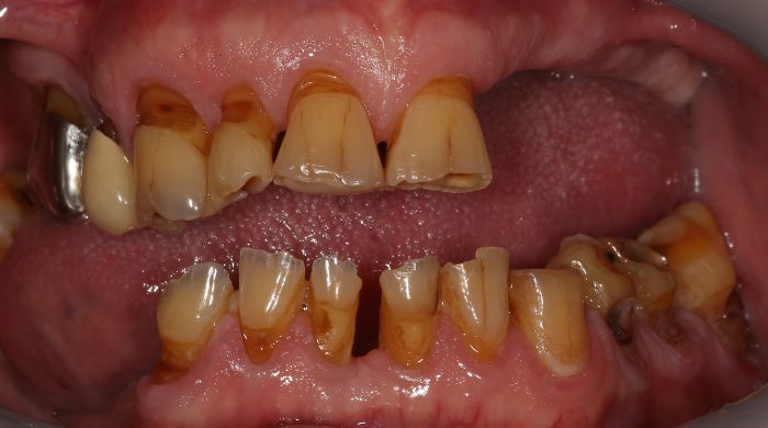 Before - Staly  Dental