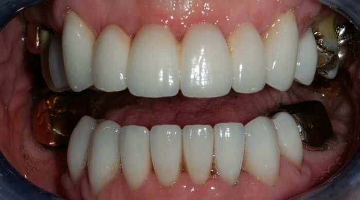 After - Staly Dental