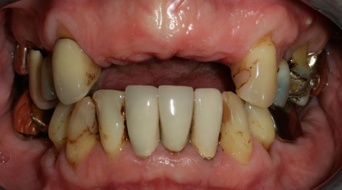 Before - Staly  Dental