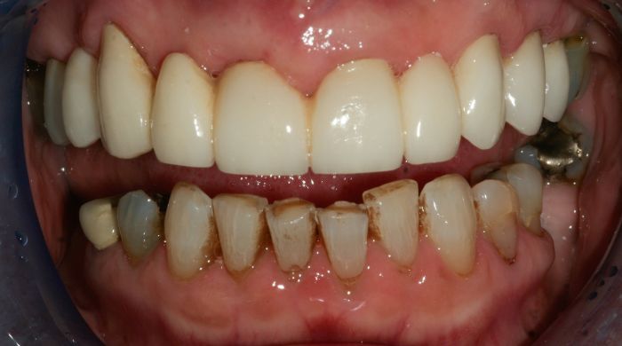 After - Staly Dental