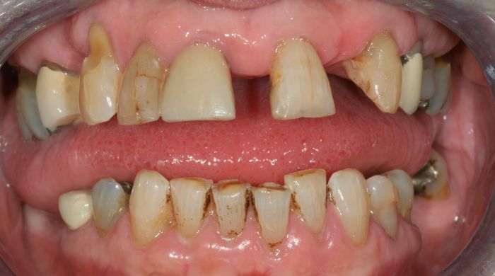 Before - Staly  Dental